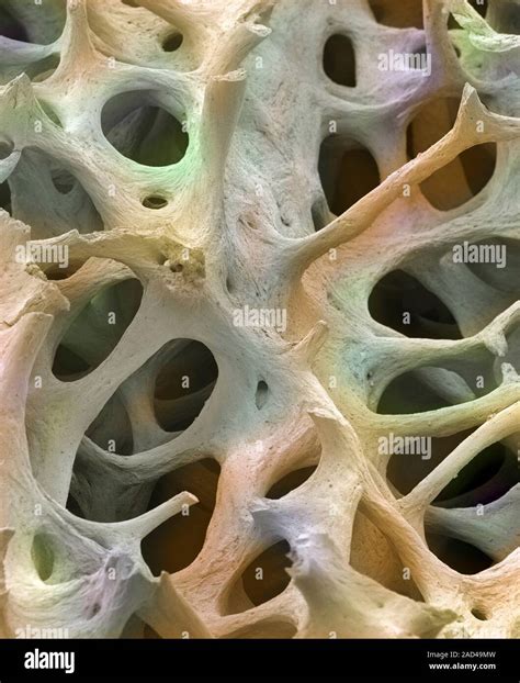 Bone Tissue Coloured Scanning Electron Micrograph Sem Of Cancellous