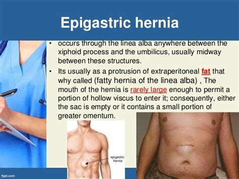 Epigastric Hernia Surgery Pictures Hernia Pictures Of 6 Common Types