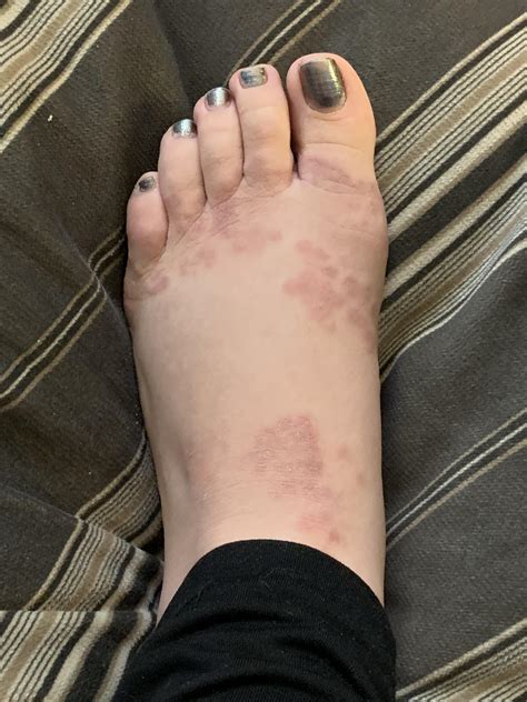 Moving Raised Foot Rash Not Painful More In Comment Diagnoseme