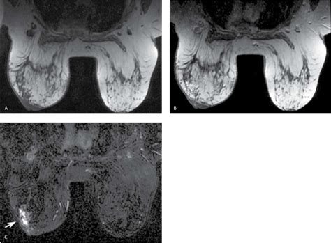 Breast Magnetic Resonance Imaging Radiology Key