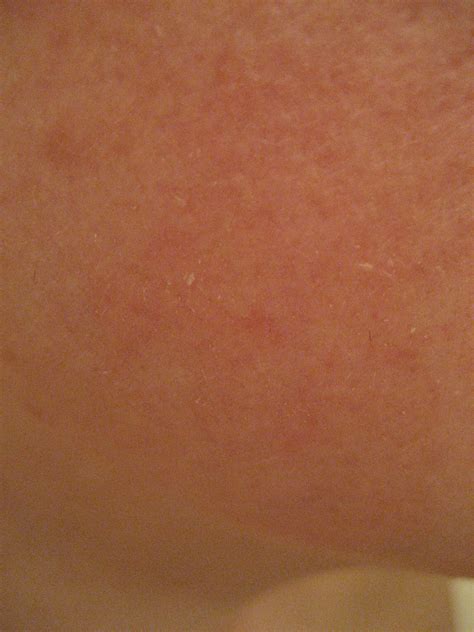 I Have A Light Pink Rash On My Right Lower Cheek That Has Been