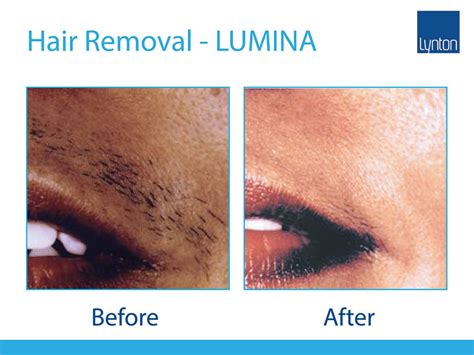 Lumina • Professional Laser And Ipl Machine • Lynton Lasers