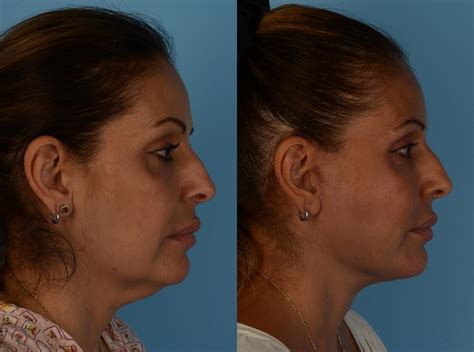 facelift neck lift before and after pictures case 259 toronto on ford plastic surgery dr