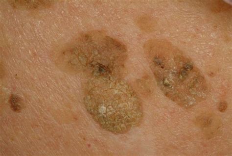 Liver Spots Pictures Face Skin Hands Causes Treatment