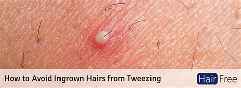 How To Stop Getting Ingrown Hairs Home Design Ideas