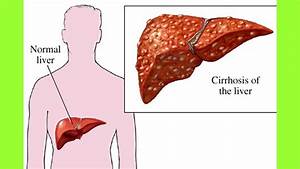 Symptoms Of Cirrhosis Of Liver - MedicineBTG.com Cirrhosis  