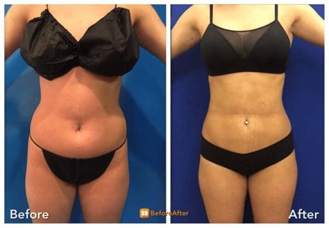 Tumescent Liposuction Neinstein Plastic Surgery