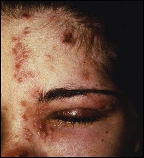 Herpes Zoster Ophthalmicus A Review For The Internist The American