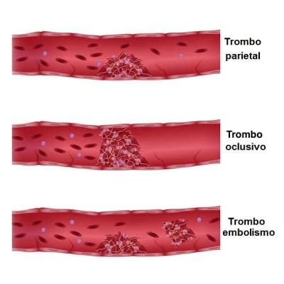 Trombose f (plural trombosen or tromboses). Trombose venosa profunda ou TVP, sintomas, tratamento e ...