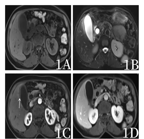 Figure 1 From Application Of 18f Fdg Petct Imaging In Gallbladder