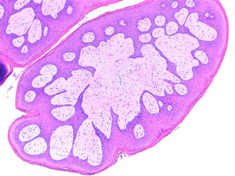 Pathology Outlines Giant Cell Fibroma