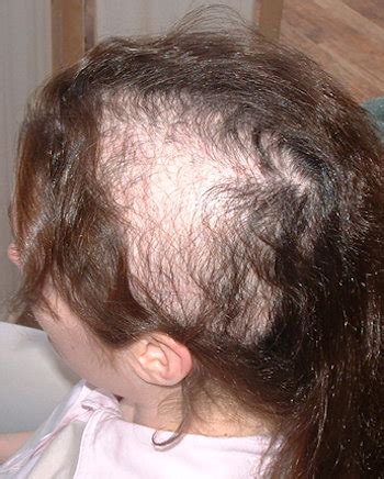 Trichotillomania Before And After Photo Library Lucinda Ellery Inc