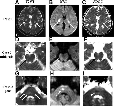 Cerebral Small Vessel Disease In Neuro Behçet Disease Journal Of