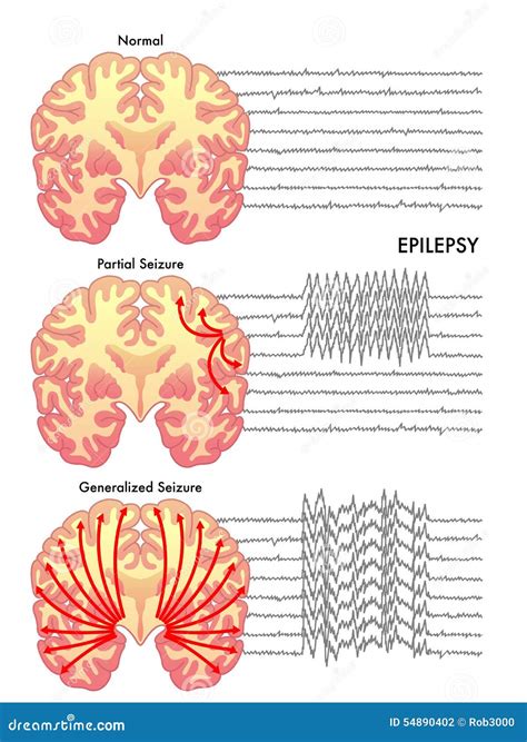 Epilepsy Stock Photo Image 54890402