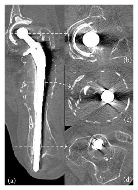 Computed Tomography Ct Images Of The Left Femur Coronal Ct Image Of