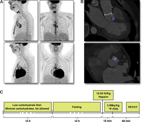 Confounders In Fdg Petct Imaging Of Suspected Prosthetic Valve