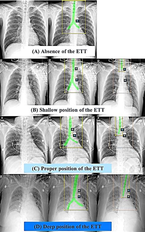 Figure 2 From Position Classification Of The Endotracheal Tube With