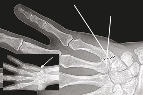 Little Metacarpal Fracture Hand Surgery Source