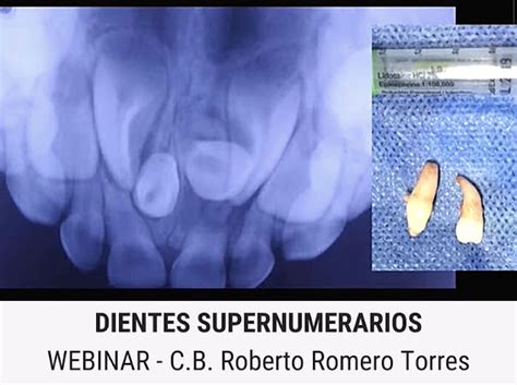 Webinar Dientes Supernumerarios Cb Roberto Romero Torres