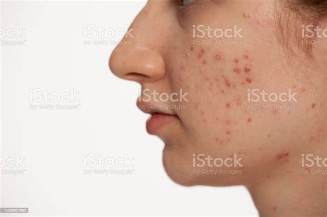Profile Closeup Of Teenage Girl With Problematic Skin On White