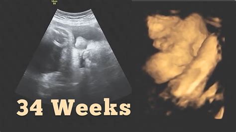 Ultrasound At 34 Weeks Pregnant 8th Month Pregnancy Growth Scan Youtube