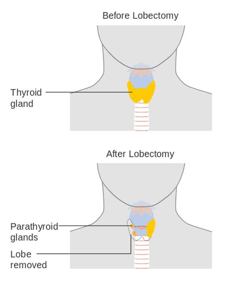 Thyroid Removal Surgery Hyperthyroidism And Hypothyroidism