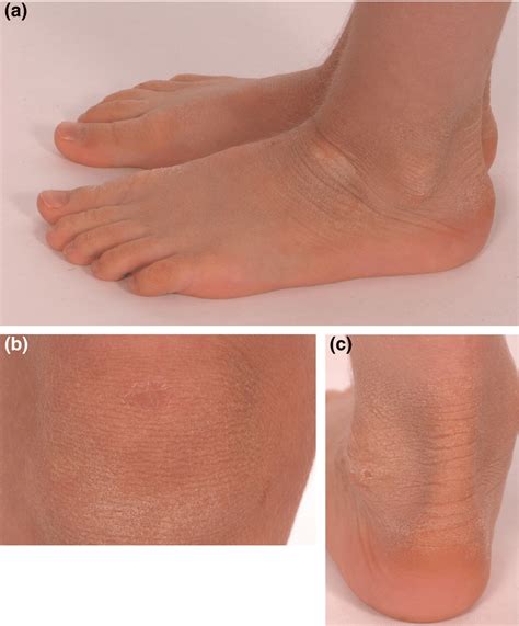 Light Grey Hyperkeratosis Overlying The Ankle And The Dorsa Of The