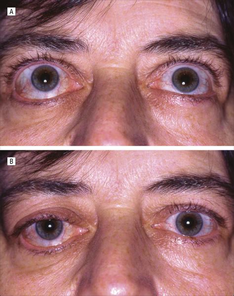 The Inferior Oblique Muscle Adherence Syndrome Ophthalmology Jama