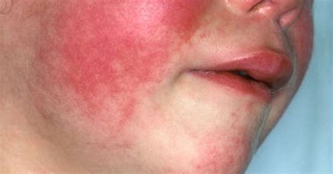 Scarlet Fever Is Making A Comeback And Parents Need To Know The Warning