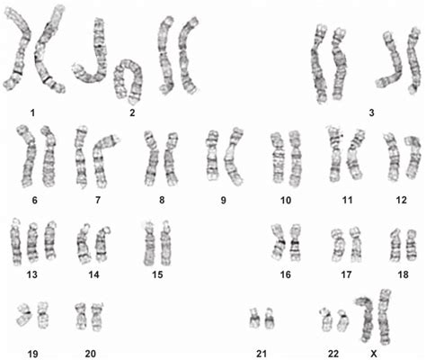 Karyotype Showing Trisomy 13 Indicated By The Extra Copy Of Chromosome