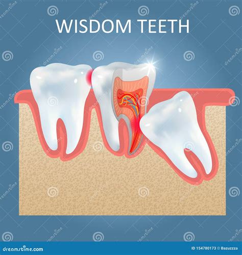 Wisdom Teeth Problems Vector Poster Design Template