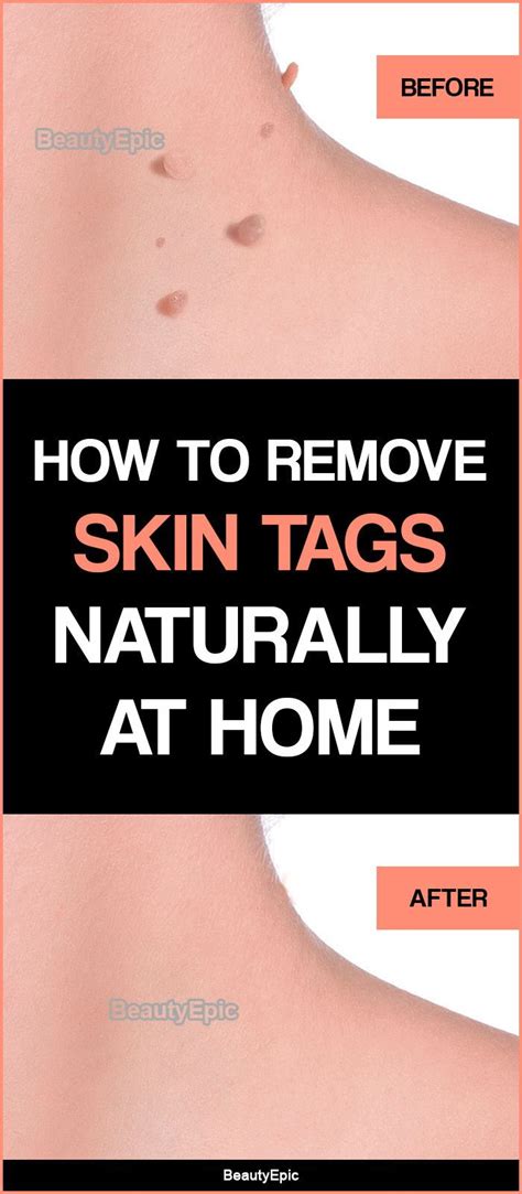 how to remove skin tags naturally at home remove skin tags naturally skin tag removal skin tag
