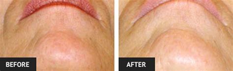 Controlled beams of laser are passed through the skin, and they render the chromophores ineffective in the hair follicles. The Benefits of Laser Hair Removal |St Louis Cosmetic ...