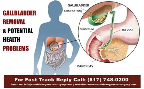 Gallbladder Problem Symptoms Treatment And Surgery Southlake Texas