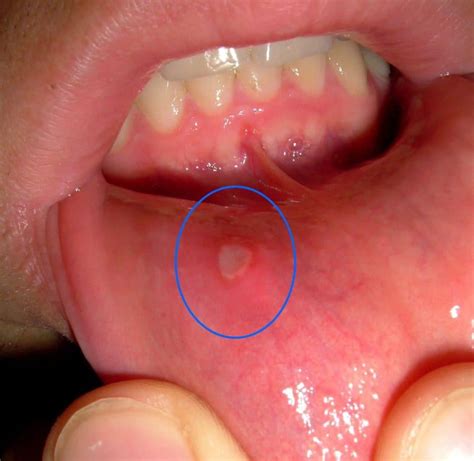 Canker Sores Causes And Prevention Dr Dana Walters