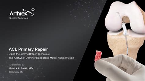 Arthrex Acl Primary Repair With Internalbrace Ligament Augmentation