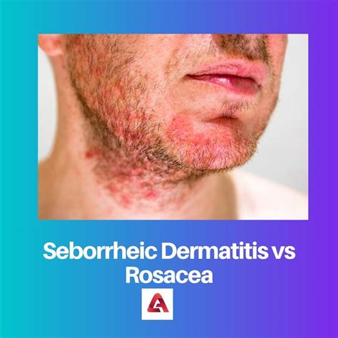Dermatitis Seborreica Vs Rosácea Diferencia Y Comparación