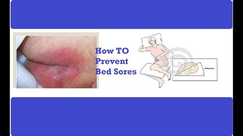 Prevent Bed Sores