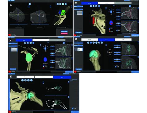 Preoperative 3d Computed Tomography Planning Example For A Patient With