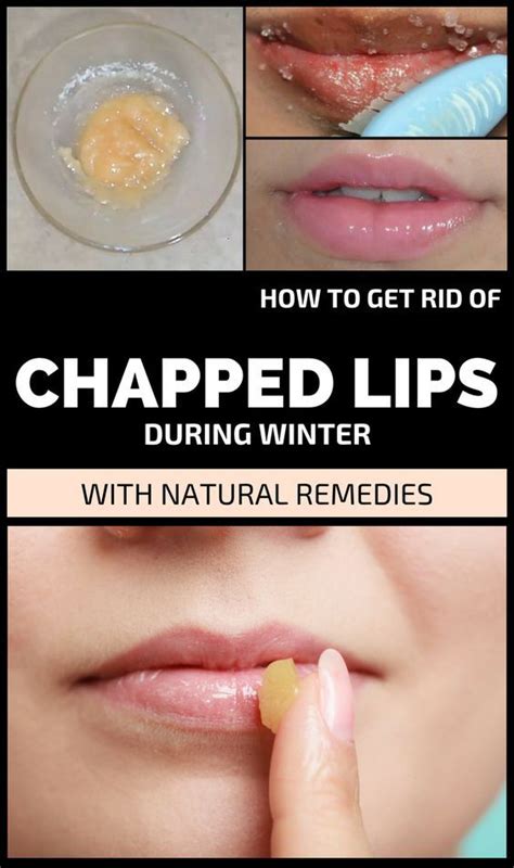 Get Rid Of Chapped Lips During Winter With Natural Remedies Dry Lips