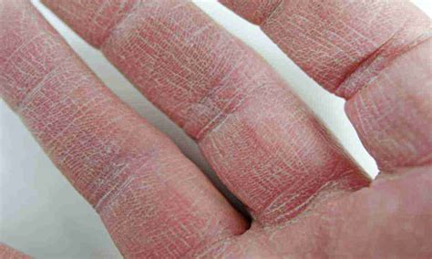 Що робити якщо облазить шкіра на пальцях рук Лікування та профілактика