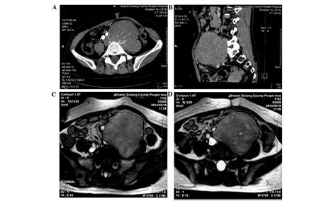 Preoperative Management Of Giant Retroperitoneal Schwannoma A Case