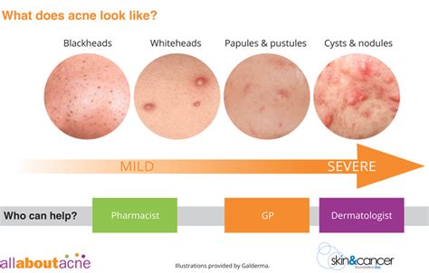 What Type Of Acne Do You Have Types Of Acne Explained