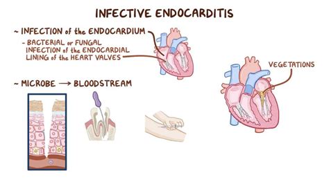 Diagnosis, antimicrobial therapy, and management of complications (endorsed). Infective endocarditis: Clinical practice - Osmosis