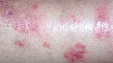 Eczema Eczema Pictures On Inner Thigh
