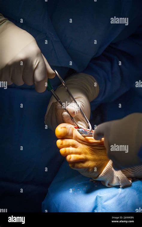 Chirurgie orthopédique salle d opération pour arthrodèse du gros orteil Photo Stock Alamy