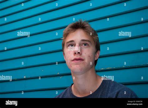 Teenage Boy With Acne Stock Photo Alamy
