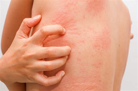 Als pfeiffersches drüsenfieber oder infektiöse mononukleose bezeichnet man eine virusinfektion, die vor allem bei kindern und jungen. Ausschlag am ganzen Körper