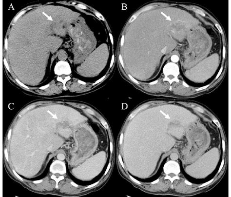 A Case Of Hepatic Sclerosed Hemangioma Mimicking Intrahepatic