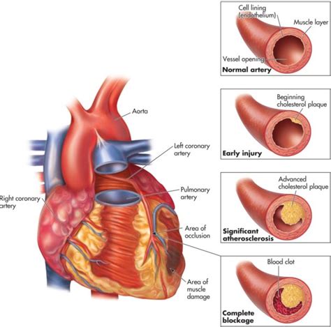 What Is Atherosclerotic Heart Disease Visit Your Cardiologist Today